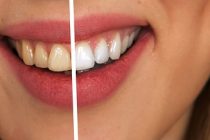 Bezbedno izbelite zube prirodnim preparatima