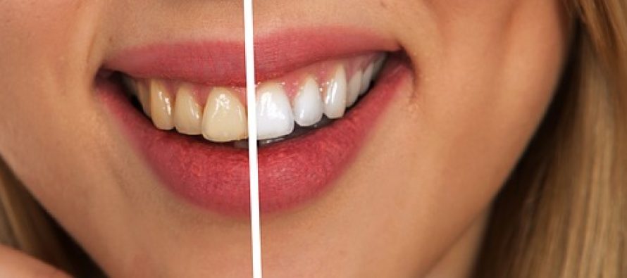 Blistavo beli ili žućkasti: Koji zubi su zdraviji?